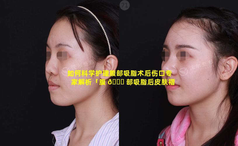 如何科学护理腹部吸脂术后伤口专家解析「腹 💐 部吸脂后皮肤褶 🌻 皱怎么消除」